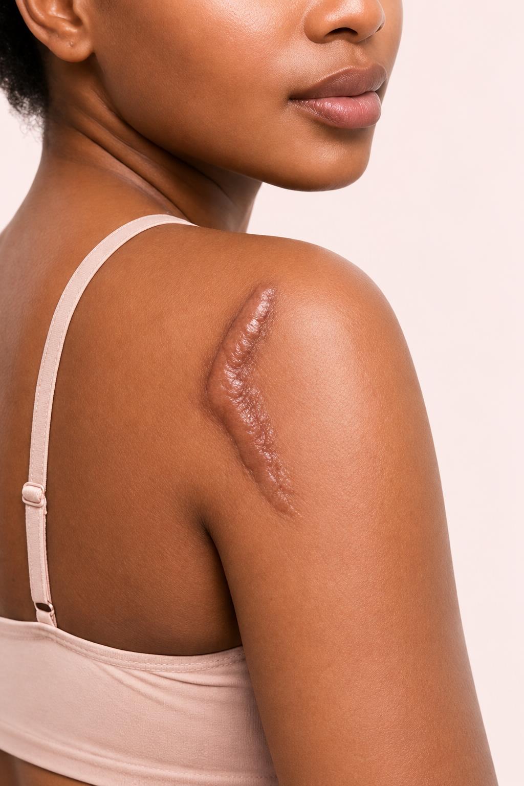 Woman with a visible shoulder scar, based on the supplied reference image